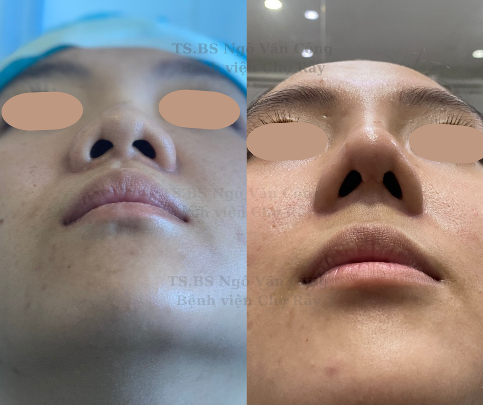 Nâng Mũi S-Line: Phương Pháp Tạo Dáng Mũi S Line Đẹp Tự Nhiên
