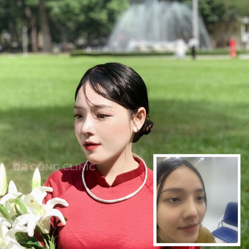 Nâng Mũi Chuẩn Dáng Hàn Quốc – Kỹ Thuật Cao Tại Phòng Khám Dr. Công